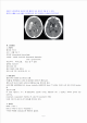 ICH-Intracerebral hemorrhage   (5 )